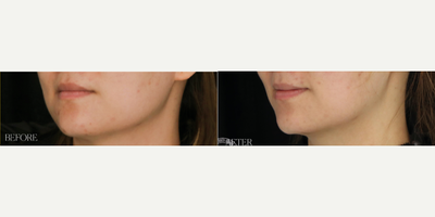 Woman treated with Mesotherapy - Woman treated with Mesotherapy