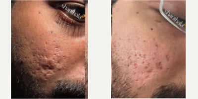 Patient treated with UltraClear Laser - Patient treated with UltraClear Laser