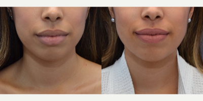 Slim Lipo of the Neck & Chin - Patient shown before and 4-months after Precision Liposculpting of the Chin & Neck by Justin Yovino, MD at Ideal Face & Body in Beverly Hills, CA
