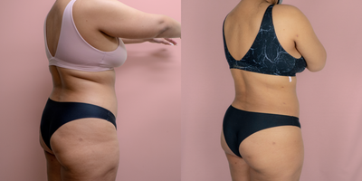 25-34 year old woman treated with Liposuction - This patient wanted only to have liposuction of her back. She is shown 2 months post-op and as you can see, the limited liposuction of her back alone still created an impressive difference in her overall shape even from the front.