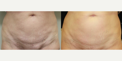 45-54 year old woman treated with EndyMed 3Deep - EndyMed 3Deep Total six weekly treatments.