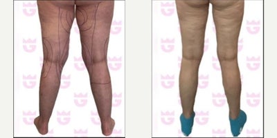 Woman treated with Liposuction - Woman treated with Liposuction.