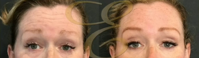 Woman treated with Botox - Woman treated with Botox