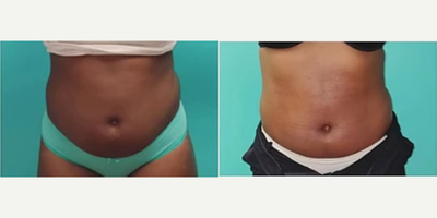 Woman treated with Lipodissolve - 3 sessions