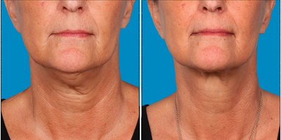 55-64 year old woman  treated with Kybella for corruption of sub mental fullness /double chin - 55-64 year old woman  treated with Kybella for corruption of sub mental fullness /double chin