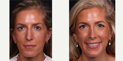 18-24 year old woman treated with Revision Rhinoplasty - Revision rhinoplasty B&A with rib cartilage grafting