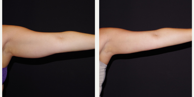 25-34 year old woman treated with Smart Lipo - 30 year old female received Smart Lipo to the arms; photos depict the patient's results 1 month post-op.