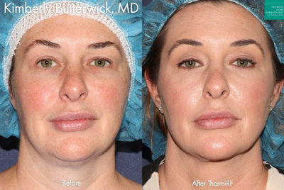 Woman treated with ThermiTight - ThermiRF to tighten skin under chin and on neck by Dr. Butterwick