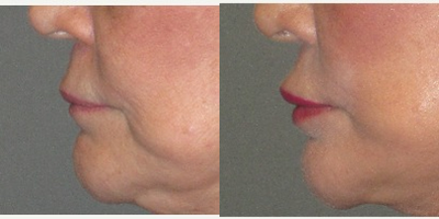 61 year old woman treated with Silicone Lip Implants - This woman in her early sixties wished for moderate permanent improvement in the volume of both her upper and lower lip.  We decided together to place medium sized PermaLip silicone implants in the top and bottom lip.  The result is a more full red body of the lip without the extreme appearance that often occurs with injectable artificial fillers.