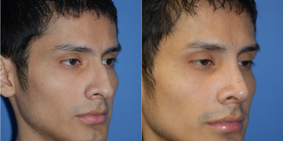 Man treated with Asian Rhinoplasty - Man treated with Asian Rhinoplasty