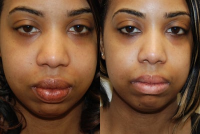 Lip Reduction Surgery. - 
	Lip Reduction Surgery