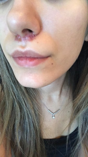 Botched Liplift Dr Omer Sagir Review Realself