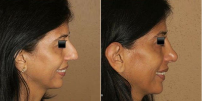 Woman treated with Rhinoplasty - Woman treated with Rhinoplasty
