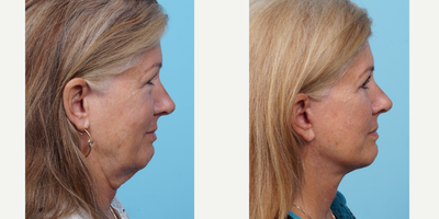 55-64 year old woman treated with Neck Lift - This patient in her 60s was concerned with the laxity and folding of her neck skin and overall tired look. She wanted to look refreshed. She had a facelift 1 year ago to elevate the structures of her neck. Note the decrease wrinkling of her neck and the decrease in hanging jowl.