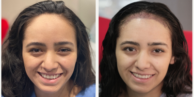 18-24 year old woman treated with Forehead Reduction Hairline Lowering - Right after surgery.  Notice the redness and how it looks before you go home.  You can also see the tiny hairs framing her new hairline.  18-24 year old woman treated with Forehead Reduction Hairline Lowering