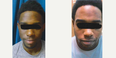 18-24 year old man treated with Skin Lightening ZO Skin Health products - Young male with hyperpigmentation treated with series of ZO skin brightener and hydroquinone.