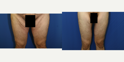35-44 year old man treated with Thigh Lift - This patient underwent a modified thigh lift to remove excess skin and fat.