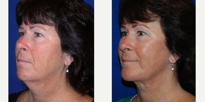 Woman treated with Neck Lift - The recovery is relatively quick with most individuals returning to work at a week to 10 days. The skin of the neck remains numb for weeks to months but eventually returns to normal.