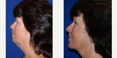 Woman treated with Neck Lift - The recovery is relatively quick with most individuals returning to work at a week to 10 days. The skin of the neck remains numb for weeks to months but eventually returns to normal.
