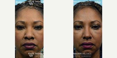 Woman treated with African American Rhinoplasty - 3 months after African American Rhinoplasty in this lovely patient. With time, the slight discoloration of the tiny incision between the nostrils will fade.