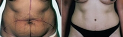 Panniculectomy - Panniculectomy