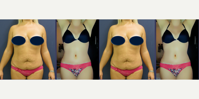 35-44 year old woman treated with Tummy Tuck - Tummy tuck with muscle repair and liposuction to contour whole abdomen