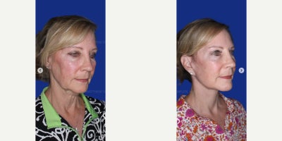 55-64 year old woman treated with Neck Lift, Facelift, Mini Facelift, Deep Plane Facelift, Lower Facelift, Brow Lift, Eyelid Sur - 55-64 year old woman treated with Neck Lift, Facelift, Mini Facelift, Deep Plane Facelift, Lower Facelift, Brow Lift, Eyelid Surgery
