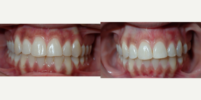25-34 year old woman treated with InBrace - Patient had history of braces as a child with relapse from not wearing retainer. She did not want to deal with the routine of clear aligners, so she chose InBrace. Treatment time was 10 months.