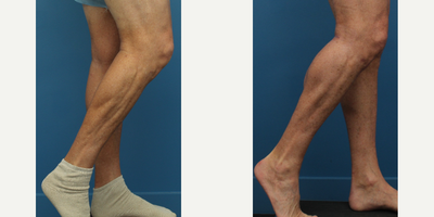 Man treated with Calf Implant - Man treated with Calf Implant