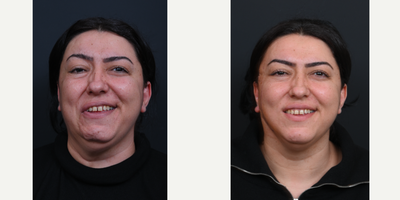 35-44 year old woman treated with Facial Reconstructive Surgery (1 week post-op) - Facial Synkinesis Surgery, Selective Denervation Surgery, Selective Neurolysis Surgery, Selective Neuroectomy Surgery