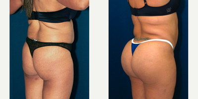 25-34 year old woman treated with Butt Augmentation - (30s yo) Butt Augmentation with patients own fat, on this 170 pound female, with 700 ccs of fat injected into her left butt cheek and 750 ccs of fat injected into her right butt cheek. (2-3 weeks)