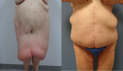 55-64 year old woman treated with Panniculectomy - 180 pound weight loss
