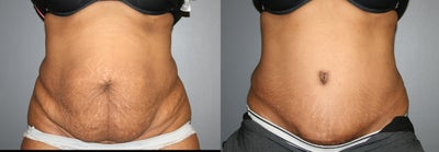 Panniculectomy - 
	Abdominal Panniculectomy, Age 38, Ht 5'4, Wt 144, 5 mos post op
