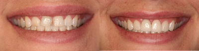 Porcelain veneers - Porcelain veneers before and after