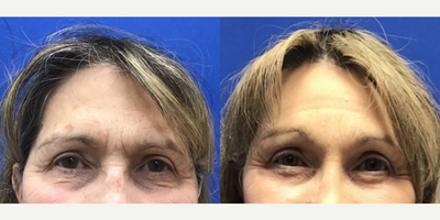 Woman treated with Forehead Reduction - Woman treated with Forehead Reduction