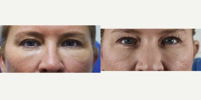 Dissolving Dermal Fillers Under the Eyes Before and After Photos Los Angeles - Filler creep.  What is it?  Filler creep is the idea that over time, some dermal filler injectors will add more and more filler ($$) until their patient looks unnatural.  In this case, we took over and had to dissolve dermal filler under the eyes to get the patent looking more natural.  Los Angeles hyaluronidase for filler dissolving.