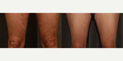60 year old woman treated with Profound SubQ for leg toning and skin tightening - 60 year old woman treated with Profound SubQ (microneedle RF) for leg toning and tightening of the skin above the knee area