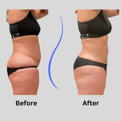 35-44 year old woman treated Funsculpting HD Lipo - 36 yr old female Funsculpting permanent belly fat removal at Blue Wolf Transformations. Down 2 inches on waistline. 1 day downtime, swelling for 2 weeks, wore compression garment 6 weeks, had 2 lymphatic massages to speed recovery.1 session only.