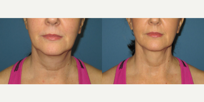 Woman treated with PrecisionTx - Liposuction - Neck / Precision TX Face & Neck