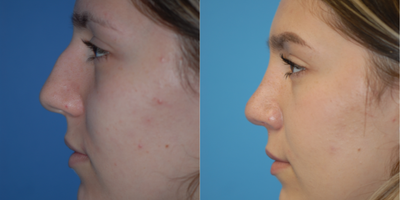 18-24 year old woman treated with Rhinoplasty - Side view is more feminine