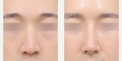25-34 year old man treated with Asian Rhinoplasty, Rhinoplasty - He had rhinoplasty (bulbous tip correction, hump smoothing, lateral osteotomy, rib cartilage)