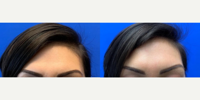 Woman treated with Botox - Woman treated with Botox for fine lines in her forehead. Patient is shown at rest in both photos.