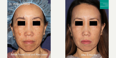 35-44 year old woman treated with Fraxel Laser - Fraxel DUAL and alexandrite lasers to treat dark spots