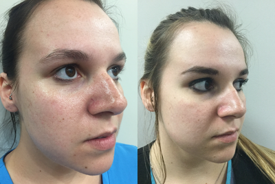 18-24 year old woman treated with ThreeForMe - Three For Me Treatment