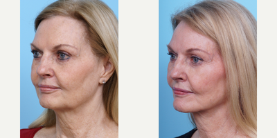 65-74 year old woman treated with Facelift - This patient had a in office mini facelift with neck liposuction to give her a short downtime with a short scar.
