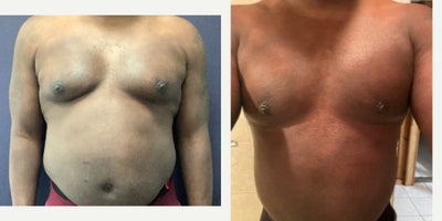 45-54 year old man treated with Breast Reduction - 45-54 year old man treated with Breast Reduction