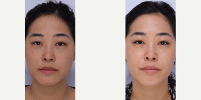 35-44 year old woman treated with BroadBand Light (BBL), Microneedling RF - 3 weeks after 1 session of BBL and RF Microneedling.