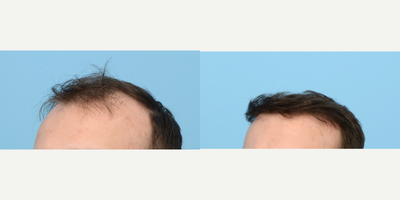 25-34 year old man treated with FUE Hair Transplant, Hair Transplant, Hair Loss Treatment, PRP for Hair Loss, NeoGraft, Low-Leve - This 28-year-old patient was experiencing thinning hair in his crown area and a receding hairline. Due to his family history of hair loss, he wanted to take action as it was progressively worsening. To rebuild hairline and add density to the crown, Dr. Wise performed an FUE hair transplant using 2,515 grafts. During the procedure, the patient also underwent PRP therapy to strengthen the follicles and expedite healing.