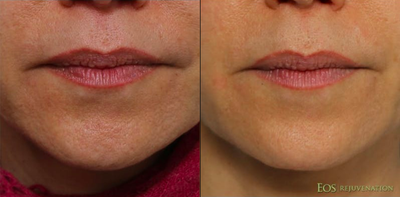 Woman treated with Microneedling - Goal: Tighten Pores and Improve Skin TextureMicroneedling has improved the quality of this patients skin.