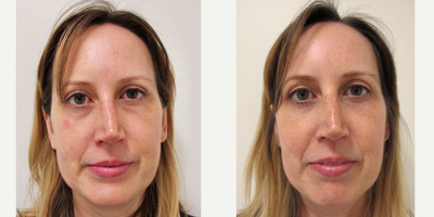 35-44 year old woman treated with Cosmetic Acupuncture - This patient underwent our 10-session Mei Zen cosmetic acupuncture series